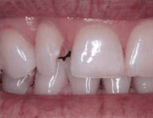 dental bonding broken tooth repair with dr michael kim dds