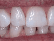 dental bonding after broken tooth repair with dr michael kim dds